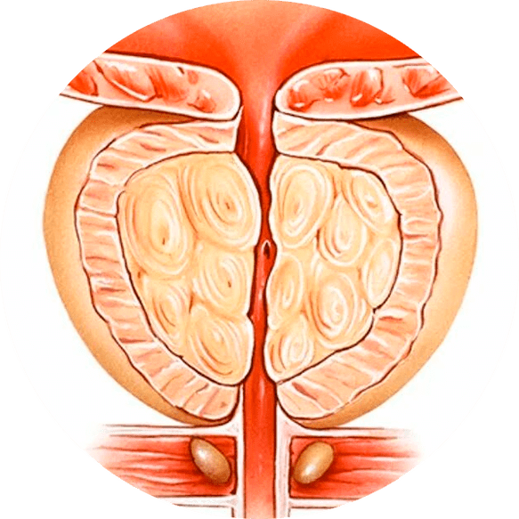 Consecuencias de la prostatitis no tratada