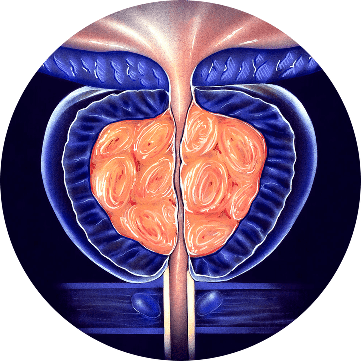 prostatitis crónica